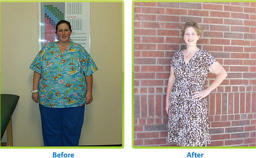 Before and after weight loss surgery