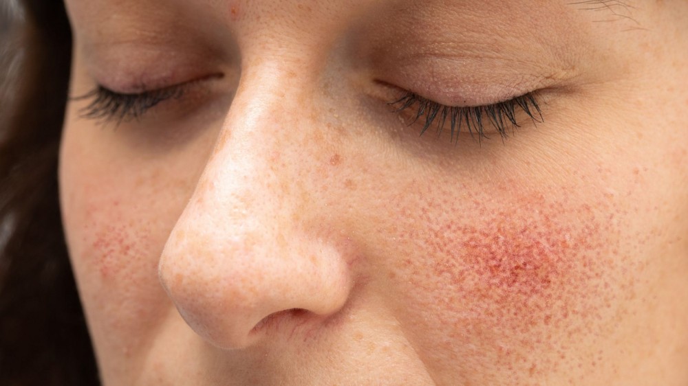 A woman with rosacea