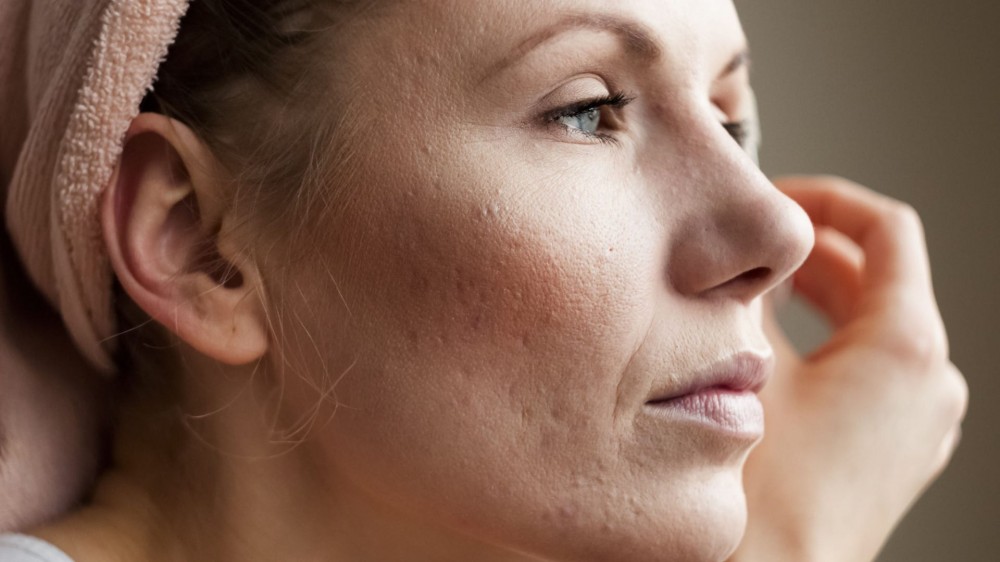 A woman with rosacea does her makeup